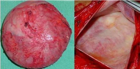 隆胸术后手感不佳是失败了吗