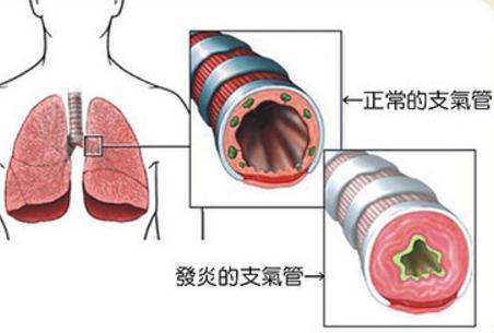 支气管炎位置图片