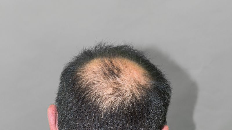 人体的“生发穴”你知道吗？抓紧学习，按摩起来！丨生发的迹象