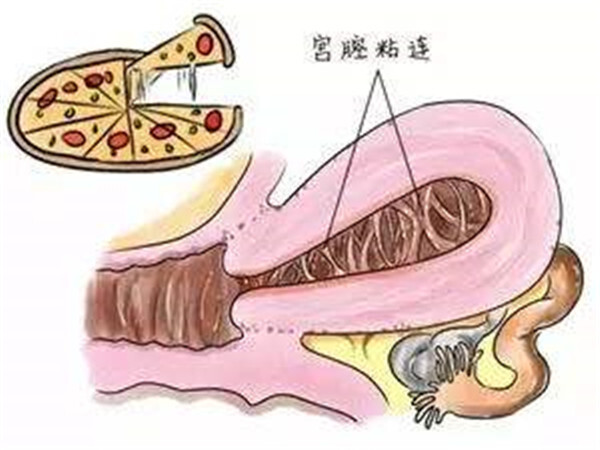 广州借卵价格（影响海外试管婴儿胚胎着床失败的常见子宫因素有哪些）