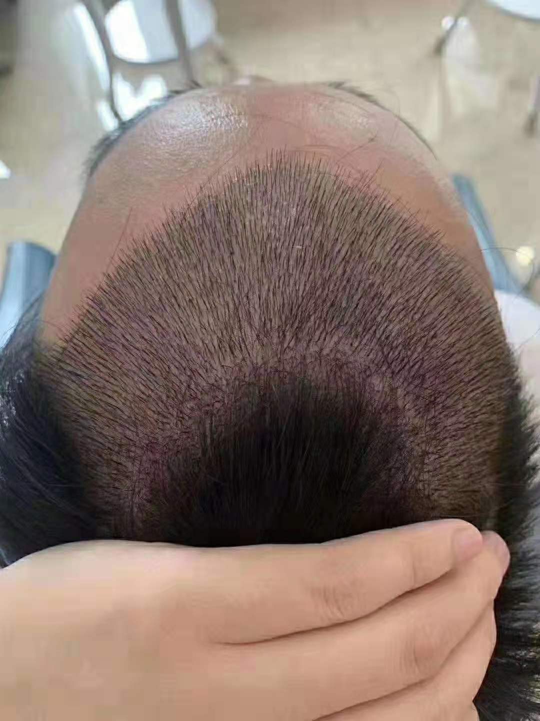怎么选择植发医院？丨如何选择植发医院
