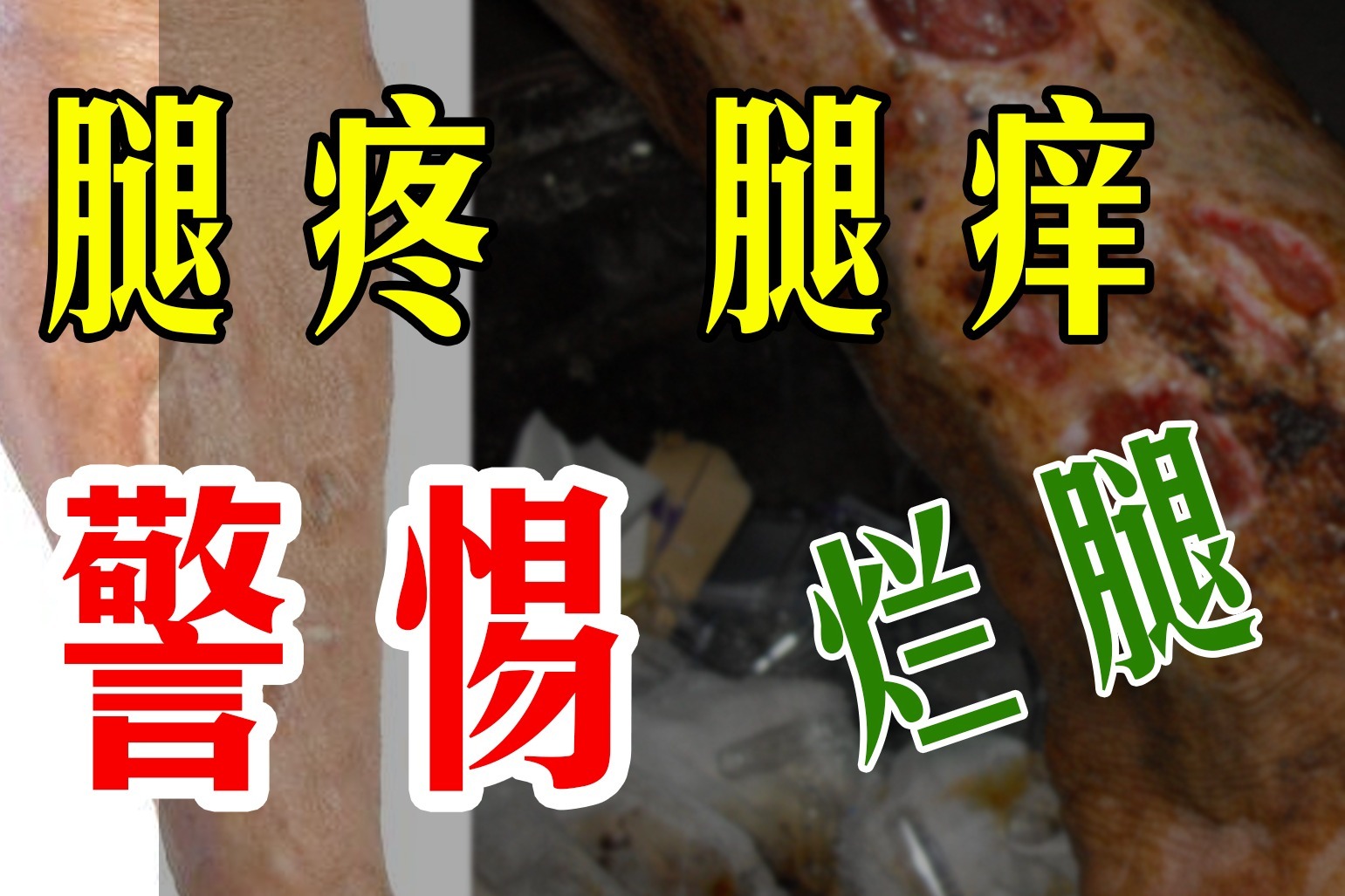 腿痒!挠也不管用!这是烂腿的信号,要警惕了!