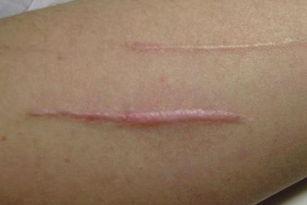 上海健桥医院：怎么处理伤口不容易留疤痕？