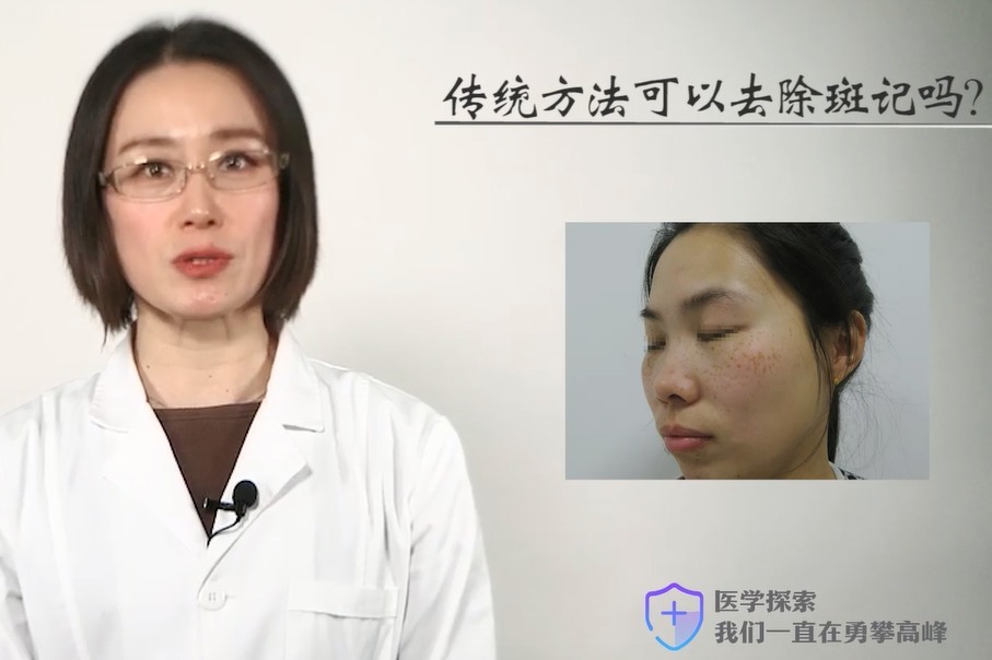 上海胎记医院上海长江医院肖萍主任传统方法可以祛除雀斑吗