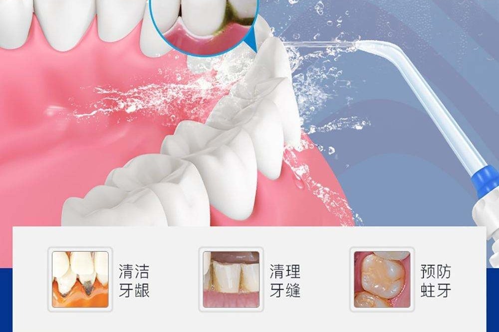 超声波洗牙预防牙齿问题!漳州洗牙