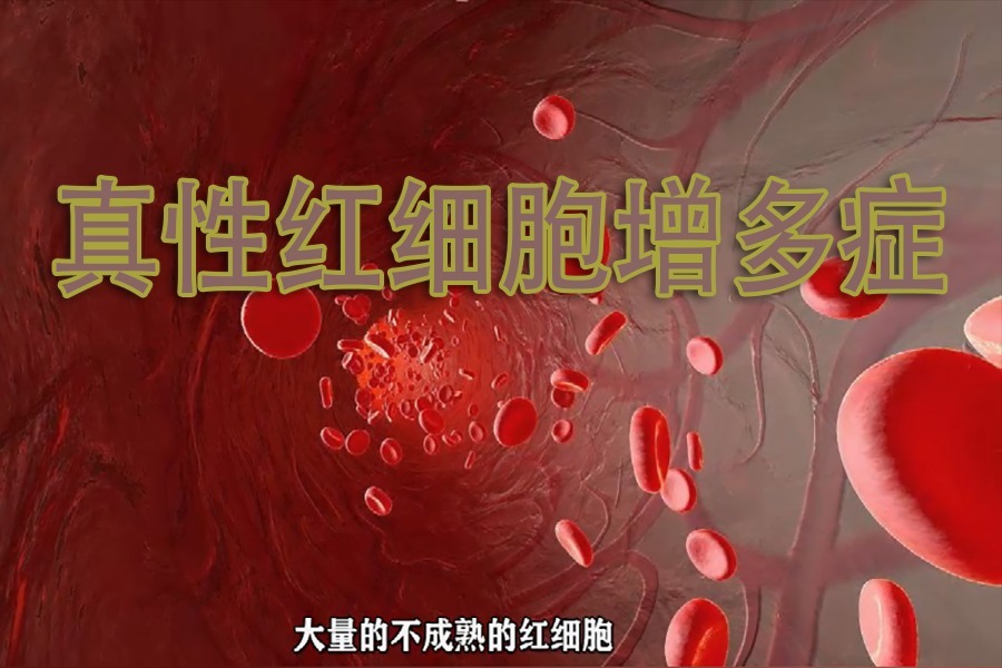 海文琪：什么是真性红细胞增多症？导致红细胞增多的原因是什么？