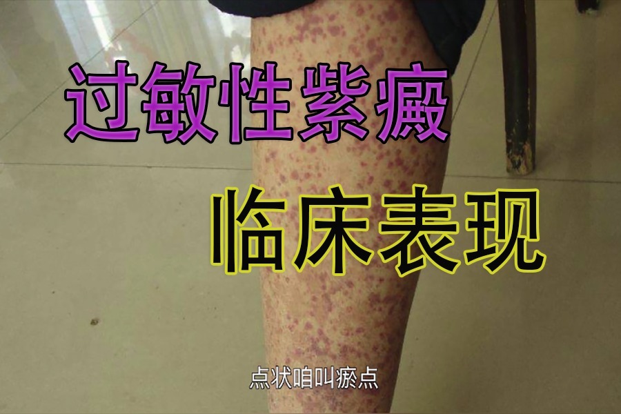 冀兆魁医生:过敏性紫癜是什么样子的? 它的临床表现有哪些