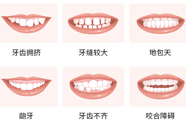 厦门神奇的正畸牙套，矫正牙齿不齐！