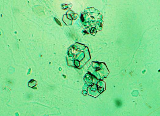 片状磷酸钙结晶图片