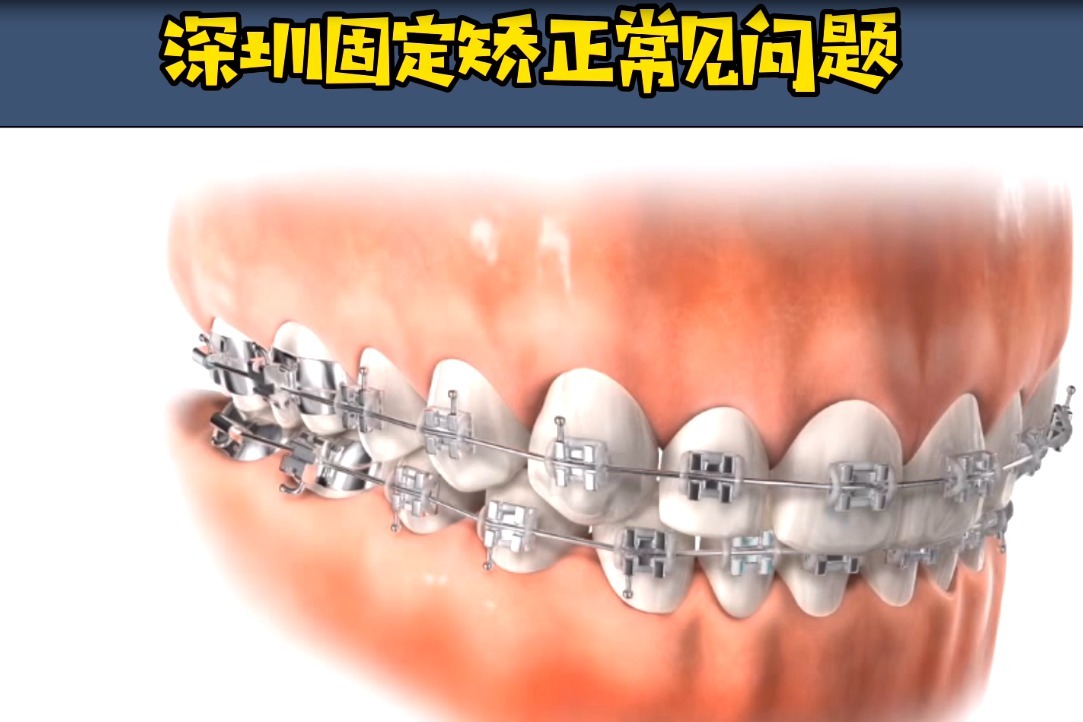 【深圳牙齿矫正】传统金属矫正常见问题