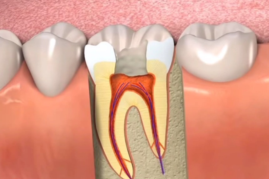 【深圳根管治疗】动画展示医生怎样进行根管治疗