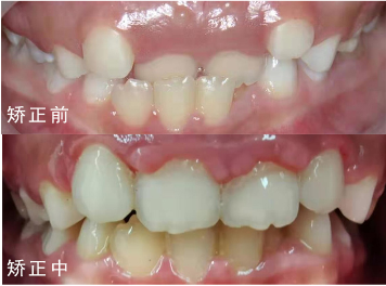 孩子矫正一定要等到12岁有这些症状父母要小心了