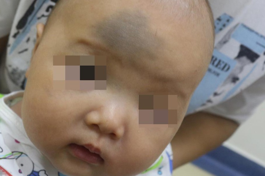 河北省中医院:婴儿青胎记是怎样形成的