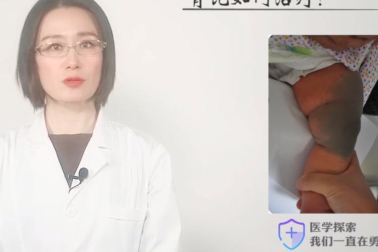 上海长江胎记医院肖萍主任:什么是青色胎记?