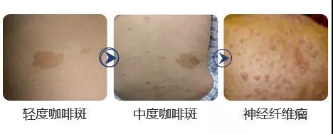 济南华夏胎记血管瘤医院:你觉得咖啡斑会影响患者的心理健康吗?