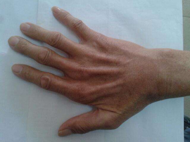 症状二: 肌肉纤维性颤动也是肌肉萎缩的主要症状之一,用拇指轻轻触摸