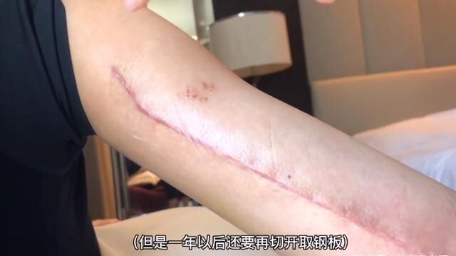 娱乐圈最飒女星手臂打满钢钉长10厘米鲜红疤痕惹哭c位对手