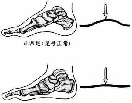 關於扁平足的成因