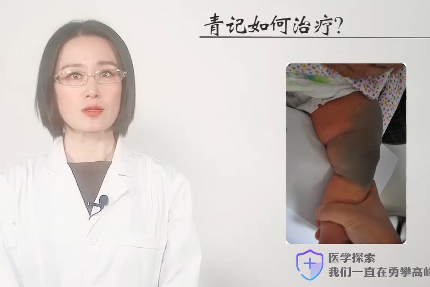 上海长江胎记医院肖萍青色胎记如何治疗