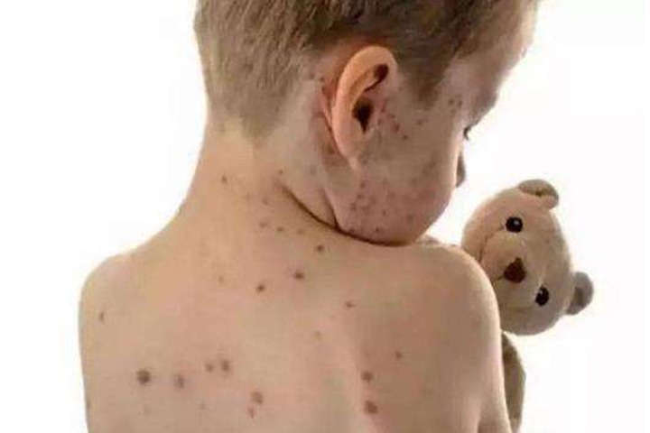 秋冬水痘高发季,儿童成人都可能中招,你不得不了解的战痘知识