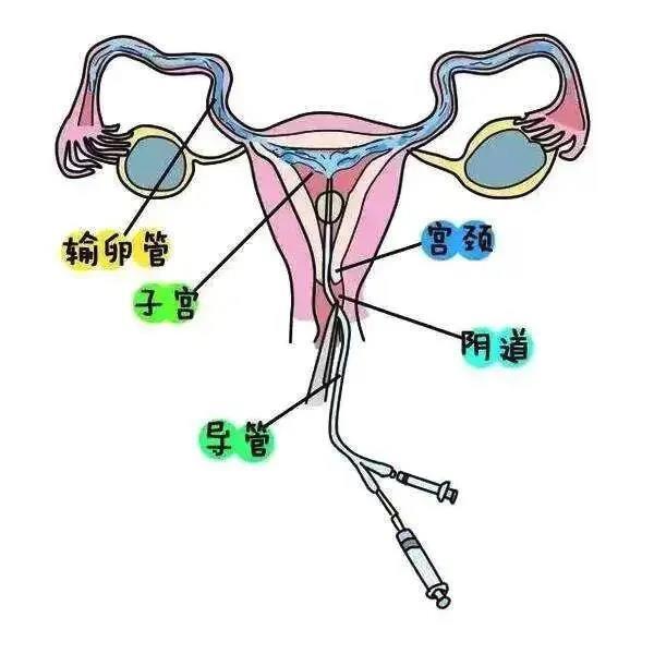 输卵管最大的危机为何通水后也没有怀孕