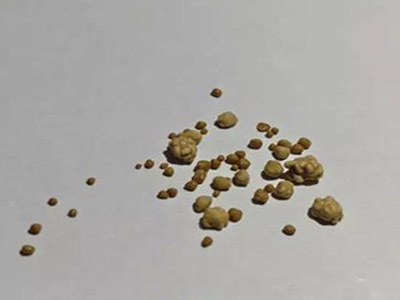 你知道胆囊息肉患者应该多吃一些什么呢?要学会多吃些有益的食物
