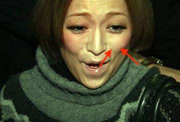 另一个是 梨状孔变大变深,使得 鼻尖下垂和 鼻唇角缩小.