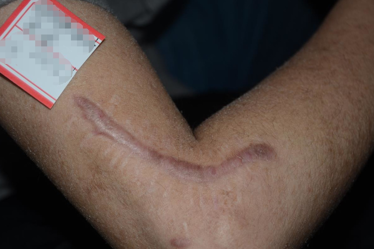 河北省中医院:术后疤痕怎么办