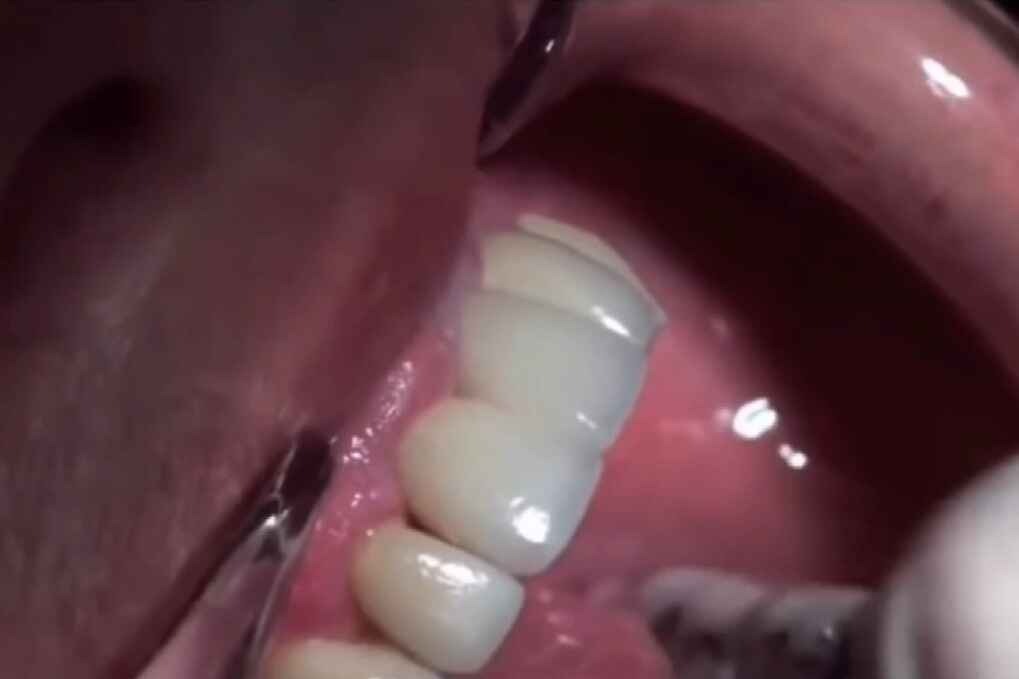 【深圳种植牙】真人展示种植牙牙冠佩戴过程