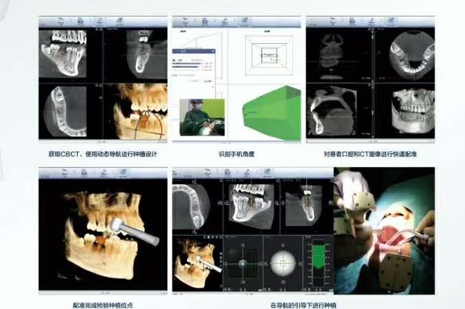 口腔动态导航种植手术全过程