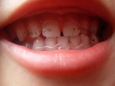 孩子的牙齿出生就有有黄色的斑块,这是典型的牙釉质发育不全