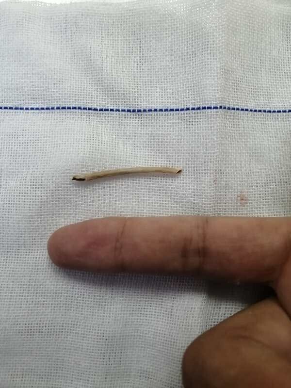 3厘米鸡骨头卡在食道4天 济南21岁男子经手术转危为安