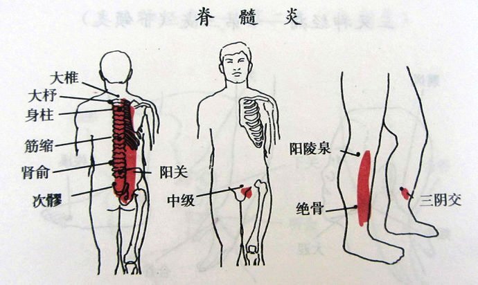 脊髓炎引起的运动障碍