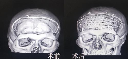 90後小夥顱骨缺損,航空總醫院穆蒼山妙手仁心重塑完整頭顱