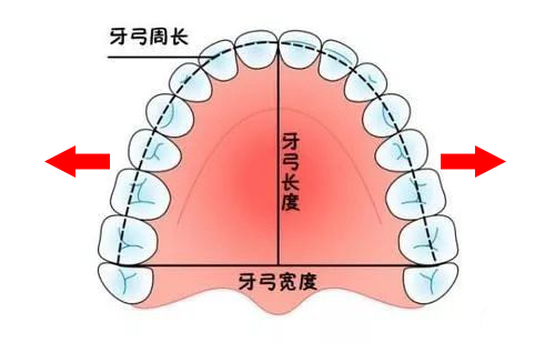 根據牙頜畸形的類型和氣道阻塞部位推薦兩種矯治形式: 上頜擴弓治療或