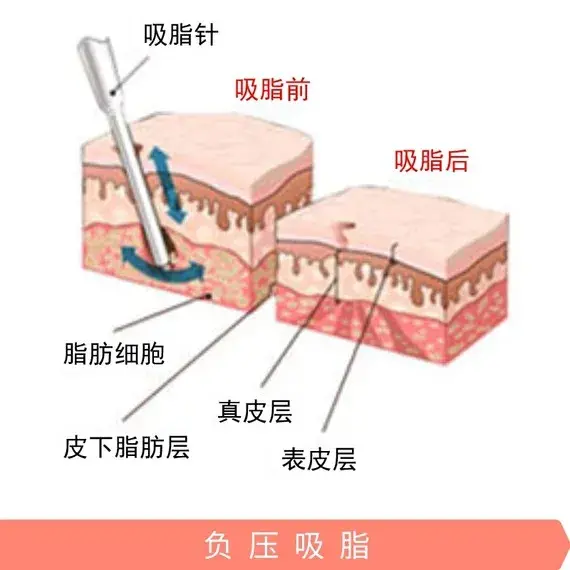北京依一整形：双下巴吸脂手术安全吗？吸脂后会不会反弹？丨依美集团有限公司