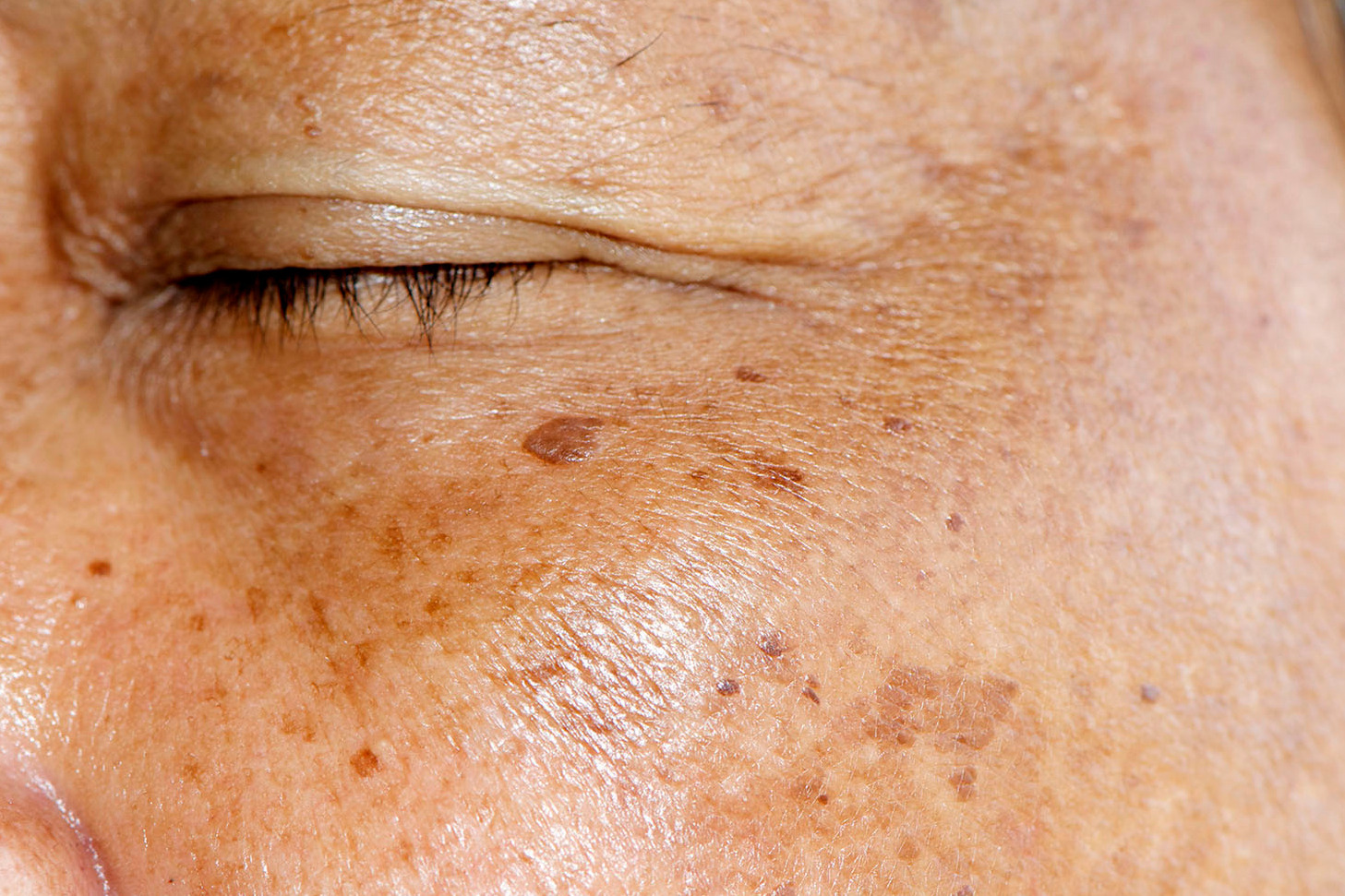 告別老人斑｜斑點，如何正確治療？ - 皮膚健康肌膚保養專家。台中EK美學診所
