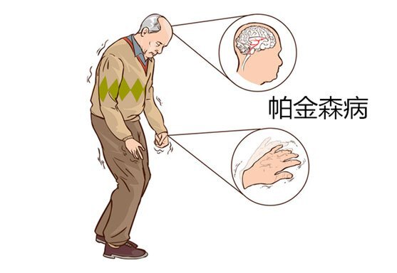 帕金森静止性震颤怎么办?__凤凰网