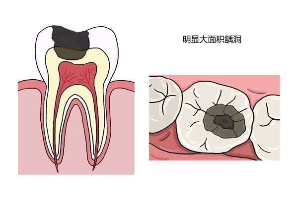 龋齿任由发展最好会怎么样？