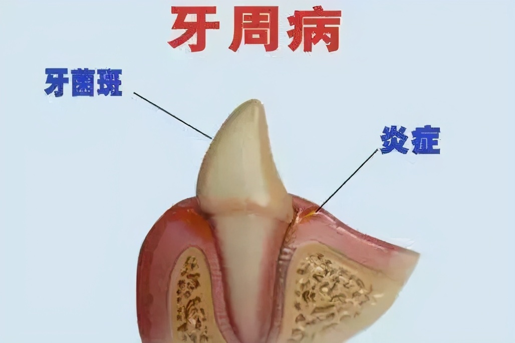 所有人,本文转给家里老人,让他们知道"老掉牙"的真相!