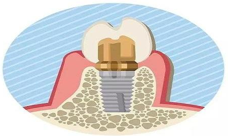 在廊坊,做种植牙为什么要植骨粉?