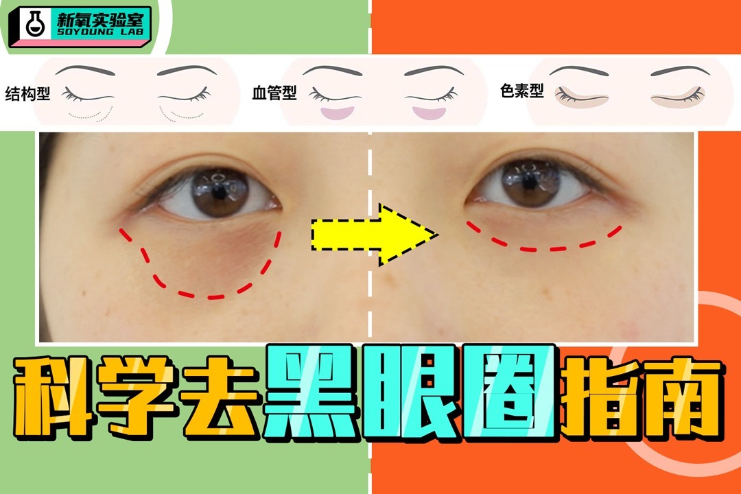 如何快速去除黑眼圈最全科普熬夜脸成素颜女神指日可待