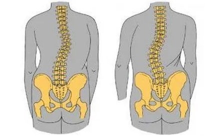 田卫国院长驼背强直性脊柱炎患者的注意事项