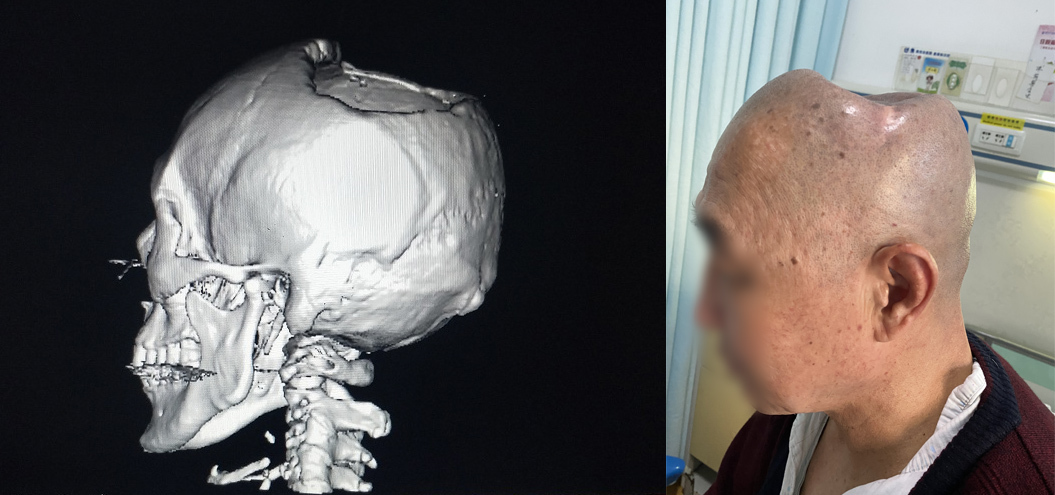 一场车祸后还剩半个头,花甲老人颅骨缺损没想到还能修好__凤凰网