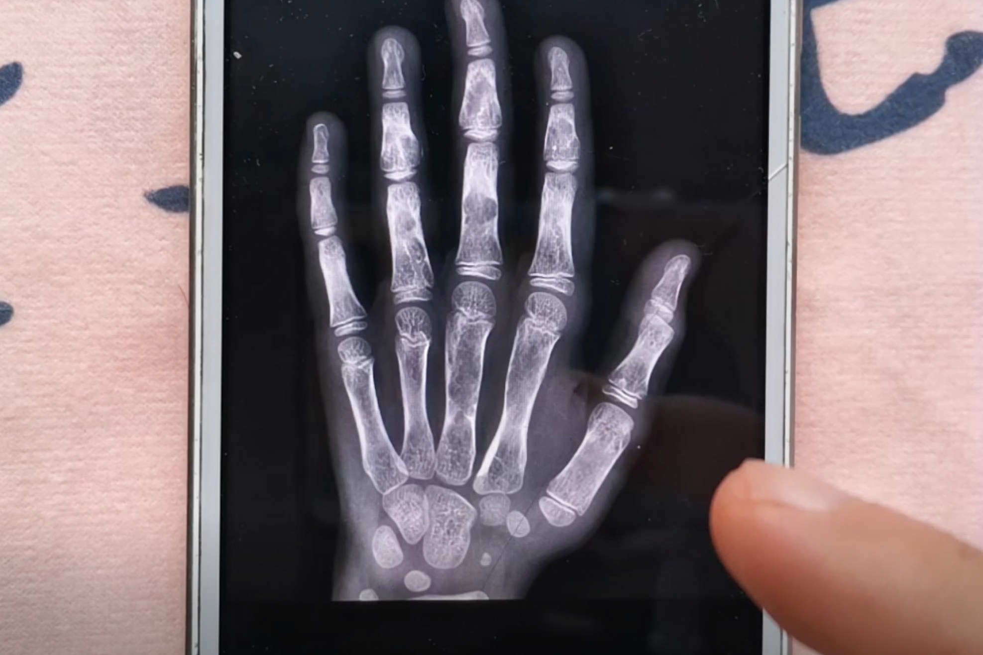 只要这样设置手机就具有透视功能手掌骨头看得一清二楚