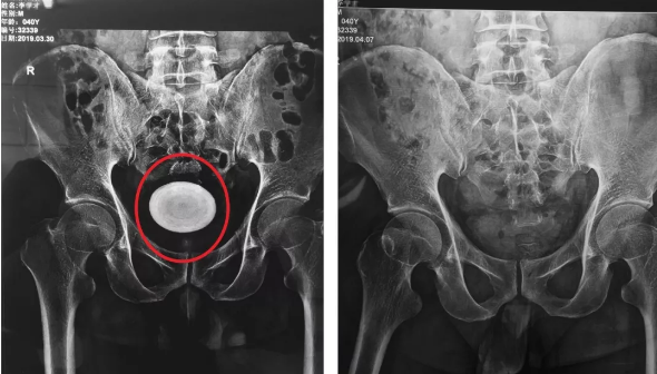 这才去了附近一家医院,被检查出膀胱多发结石