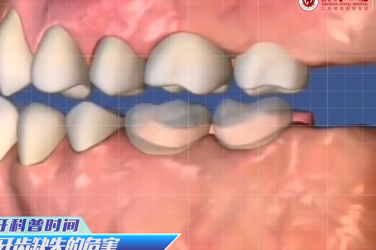 15秒看懂系列：牙齿缺失后你的口腔会变成啥样？