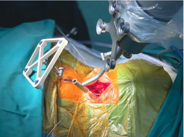天玑骨科手术机器人携手3d显微镜成功完成高难度上颈椎手术