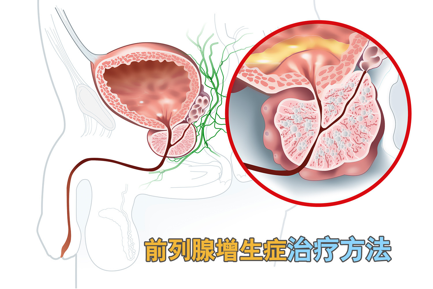前列腺增生彩超报告单图片