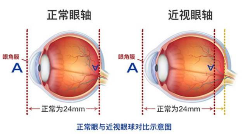 导致近视最核心的原因就是长时间的近距离用眼,学习时间太长,作业太多